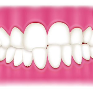 健康的に見える！綺麗なピンク色になれる「歯茎のピーリング」とは
