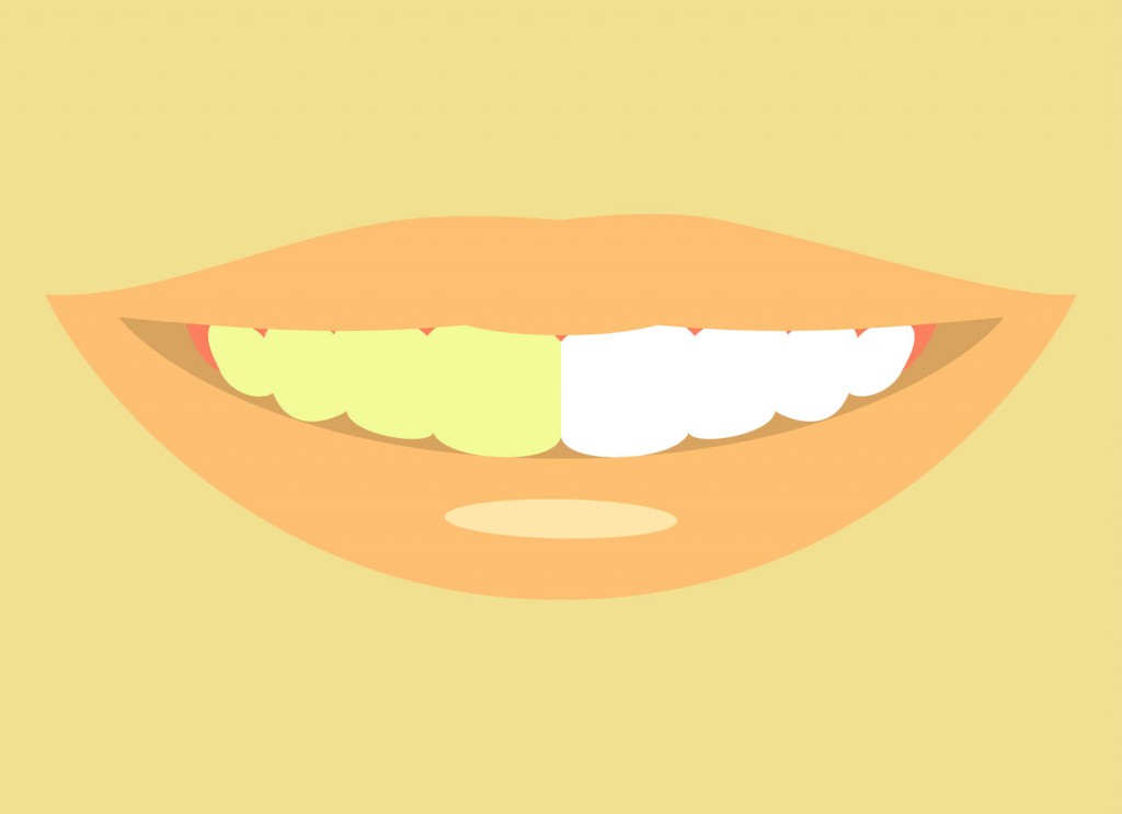 歯の黄ばみ