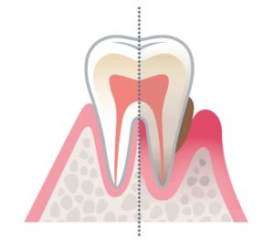 歯のエナメル質と象牙質