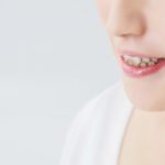 歯の矯正の種類はどれくらい？実際にかかる費用と期間は？