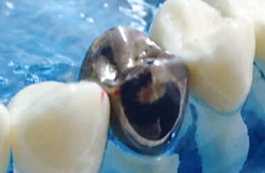 金銀パラジウム合金(銀歯)