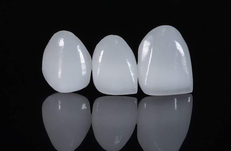 ラミネートベニア