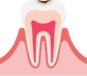 歯の表面のむし歯