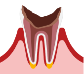 末期のむし歯