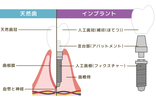インプラントと天然歯の断面図比較