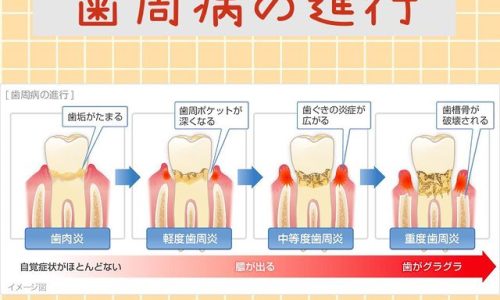 歯周病